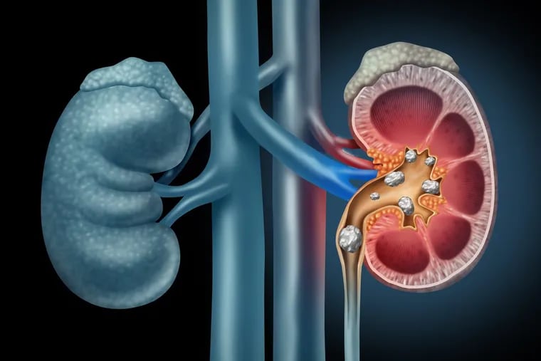 Kidney stones affect approximately 11% of men and 6% of women.