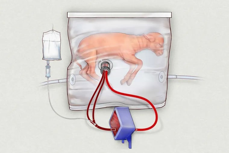 With colleagues at Children’s Hospital of Philadelphia, fetal surgeon Alan W. Flake kept extremely premature lambs alive for weeks inside a fluid-filled bag.