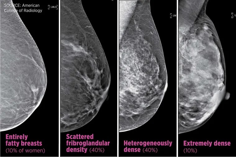Breasts are made up of a mixture of fibrous, glandular (both considered "dense") and fatty tissue. Dense breast tissue can block breast X-rays, making it hard to find a malignancy.