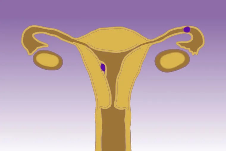 In a normal pregnancy, the fertilized egg implants in the uterus, shown by the purple dot in the center. In an ectopic pregnancy, the egg can implant in the fallopian tube (upper right), where it cannot survive.