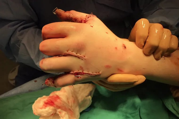 A patient's hand after surgery to repair a fireworks injury. Surgeons might consider this a best case scenario.