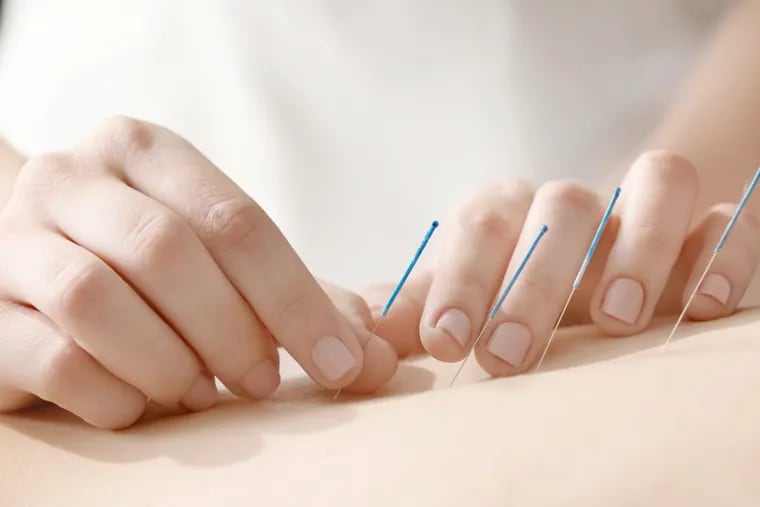 Stock image showing how tiny needles are used in acupuncture, an alternative medicine prevalent in China.