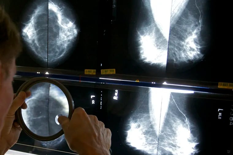 A radiologist uses a magnifying glass to check mammograms for breast cancer in Los Angeles in 2010.