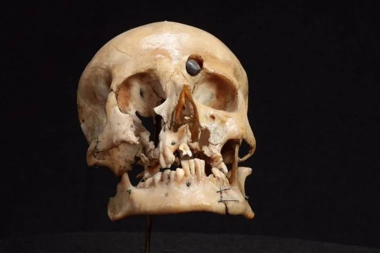This skull of an Australian soldier who was killed in World War I hate been on display at the medical  museum.