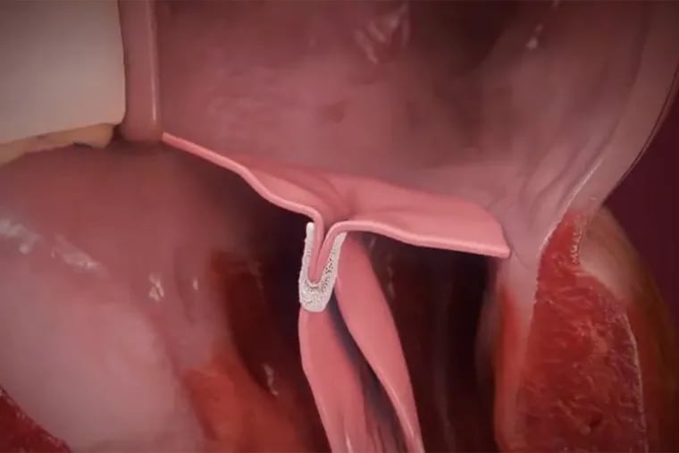 Heart-failure patients who had this tiny clip implanted in their mitral valves were less likely to be hospitalized than those who did not receive the clip.