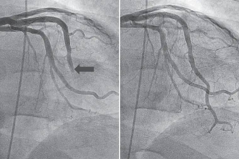 Spasms in smaller arteries caused restricted blood flow in a patient's heart where indicated by the arrow, left. Normal flow was restored with a generic drug, as reported in the Journal of Invasive Cardiology.