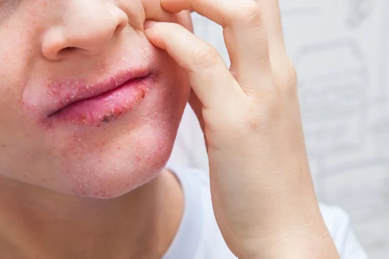 Surrounding the 7-year-old boy's lips were multiple crusts and some large blisters.
