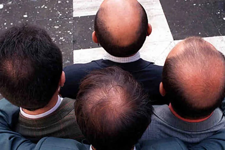 Various estimates have placed the number of men with male-pattern baldness at more than 35 million in the U.S. (CORRADO GIAMBALVO / Associated Press)
