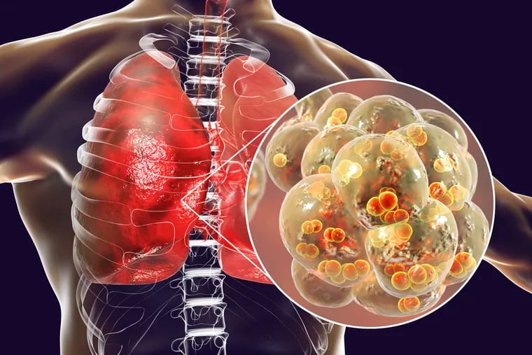 Pneumonia is an infection that inflames the air sacs in the lungs.