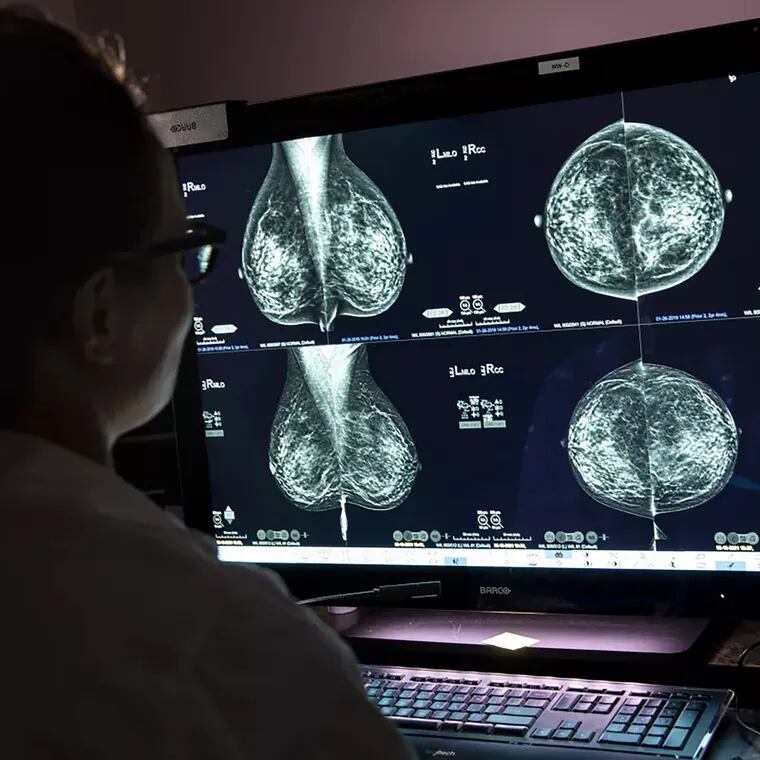 A draft recommendation from the U.S. Preventive Services Task Force says breast cancer screening should start at age 40 to benefit groups including Black women and women with dense breasts.