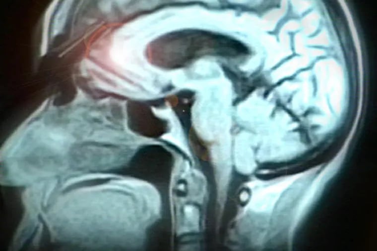 Meningiomas are tumors that develop from the covering of the brain – the meninges.