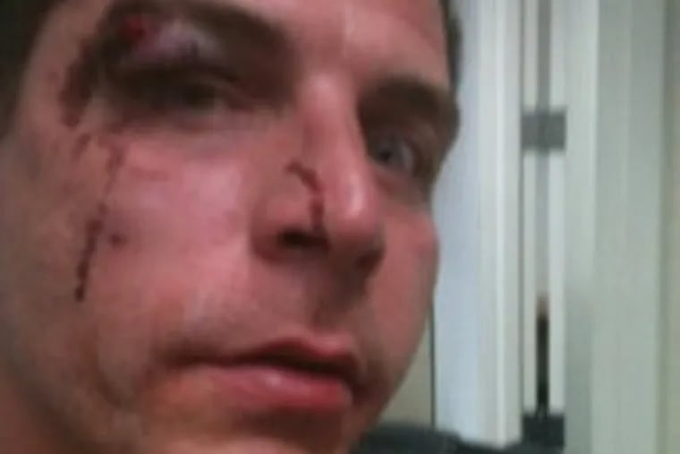 Anthony Flora, 36, said he was the victim of an unprovoked attack at the hands of security guards at Harrah's Atlantic City. He took this selfie soon after the alleged assault.