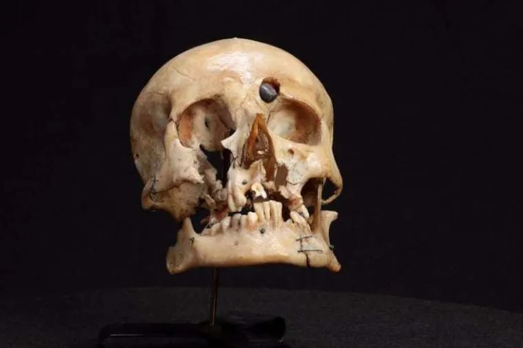 This skull of an Australian soldier who was killed in World War I hate been on display at the Mutter Museum.
