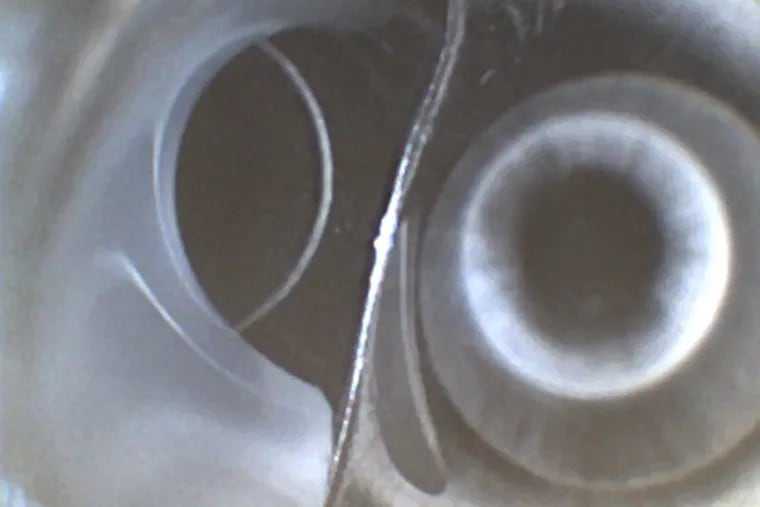 Whitish fluid found in the suction port of a pediatric colonoscope.