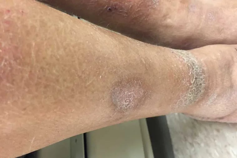 This handout image shows skin lesions on a 41-year-old man who went to the doctor complaining of tingling in his hands and feet.