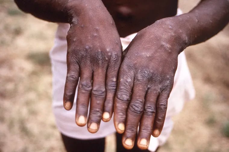FILE - This 1997 image provided by the CDC during an investigation into an outbreak of monkeypox, which took place in the Democratic Republic of the Congo (DRC), formerly Zaire, and depicts the dorsal surfaces of the hands of a monkeypox case patient, who was displaying the appearance of the characteristic rash during its recuperative stage. The World Health Organization is convening its emergency committee  on Thursday, July 21, 2022 to consider for the second time within weeks whether the expanding outbreak of monkeypox should be declared a global crisis.