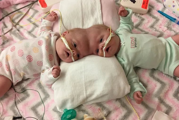 On Tuesday, surgeons at CHOP successfully completed the separation of 10-month-old conjoined twins Erin and Abby Delaney. The infant girls, from North Carolina, were joined at the top of their heads, a condition called craniopagus.