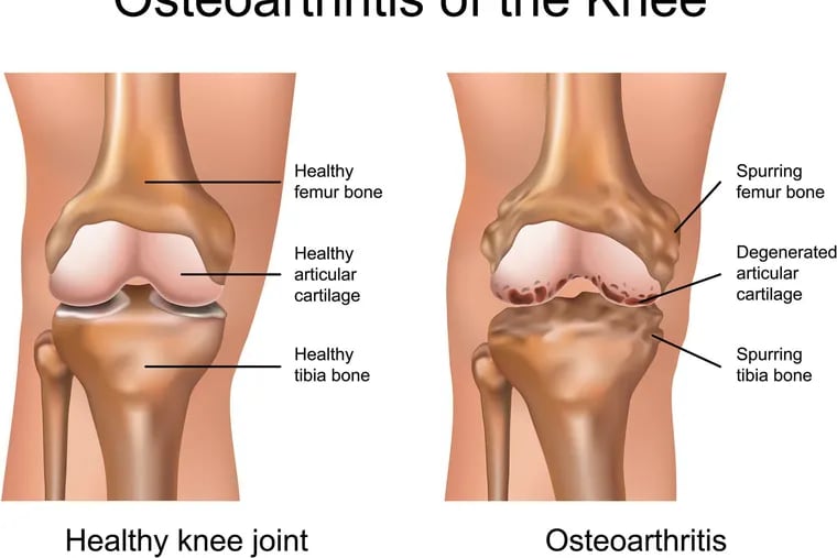 A diagram compares a healthy knee joint to one with osteoarthritis. The Philadelphia Veterans Administration is launching a research center to develop new treatments for the disease.