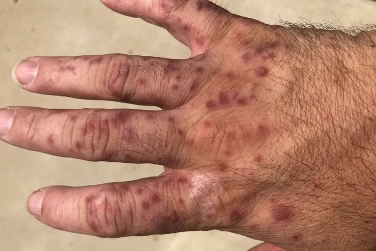 Todd Shevlin, of Devon, developed a bad rash after what he suspects was an encounter with a jellyfish larvae.