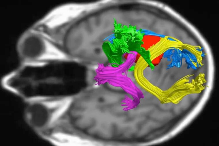 An example of diffusion tensor imaging shows a tumor in red surrounded by a bundle of critical brain circuitry. (Photo by Arlan Mintz, Capital Health / enhanced at University of Pittsburgh Medical Center)