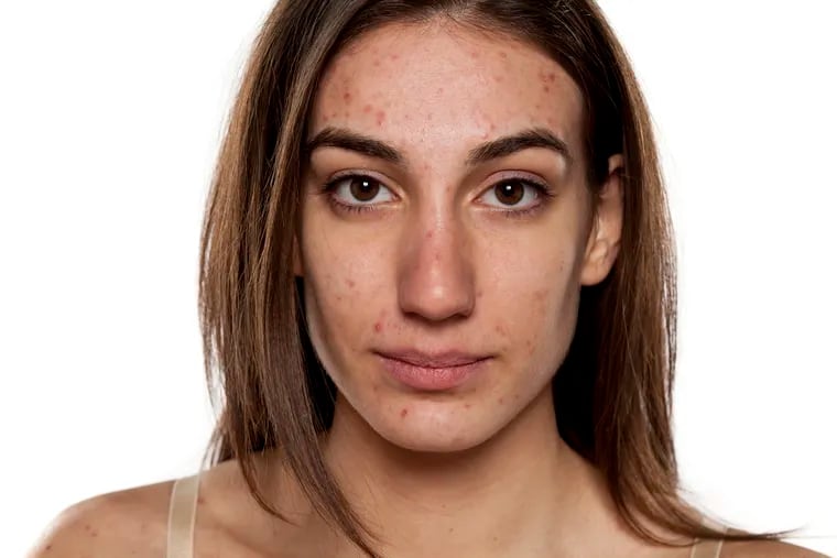 Acne is not just for teenagers. It affects 40-50 million Americans a year, many of whom are adults. Women are affected more by acne, making up 80 percent of all adult cases.