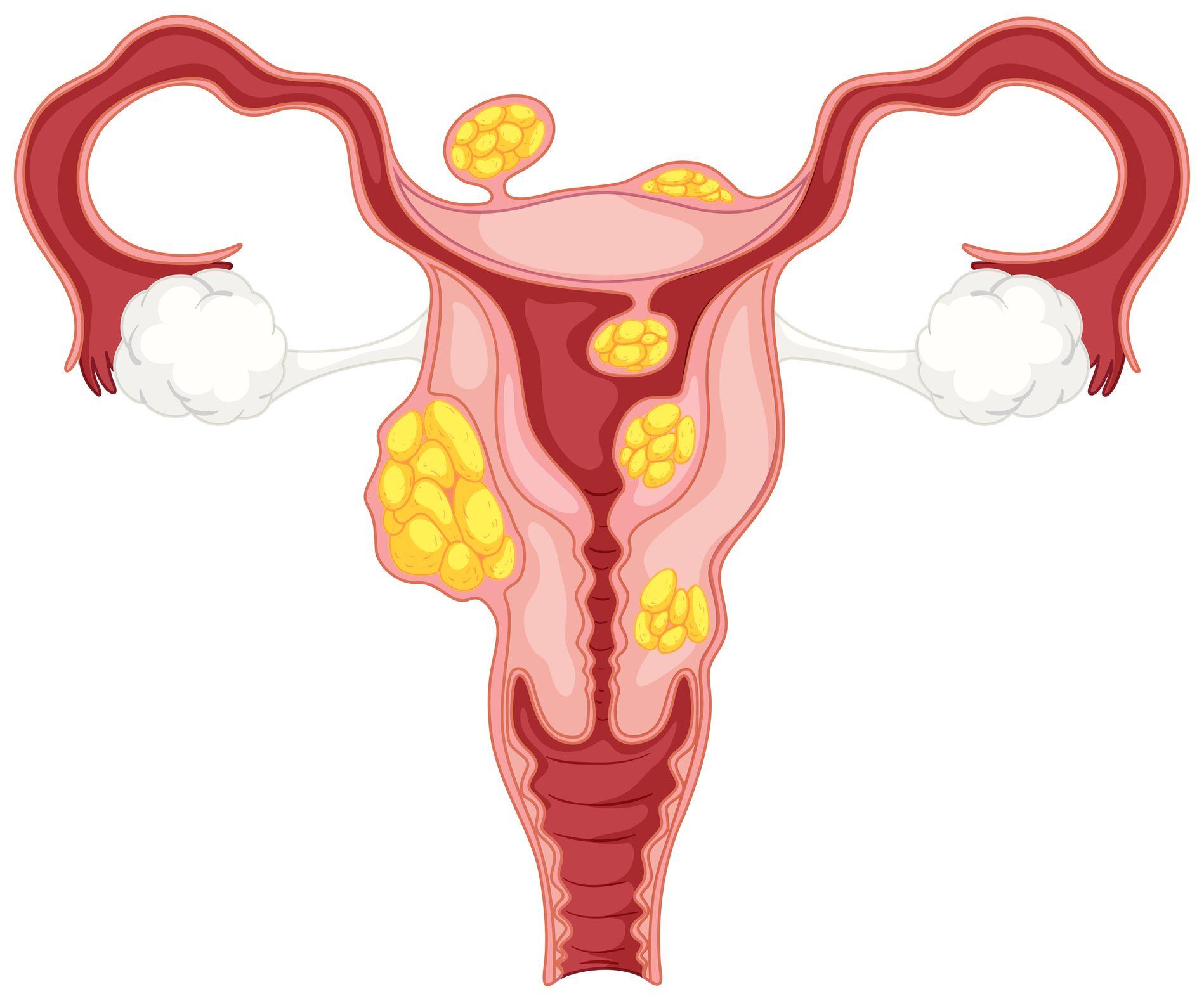 glp 1 fibroids What are uterine fibroids and how are they treated?