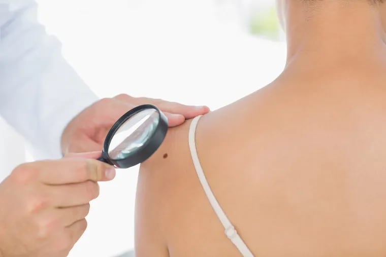 Routine skin checks by a dermatologist can help monitor for skin cancer.