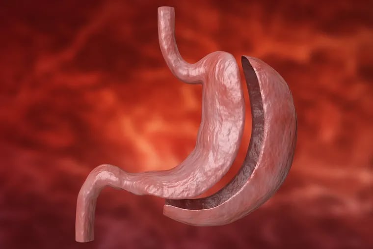 Sleeve gastrectomy is a restrictive procedure that removes approximately 80% of the stomach.