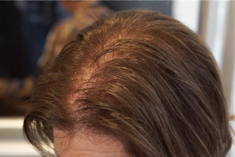 This woman, a client of Giovanni and Pileggi salon in Philadelphia, has female pattern hair loss.