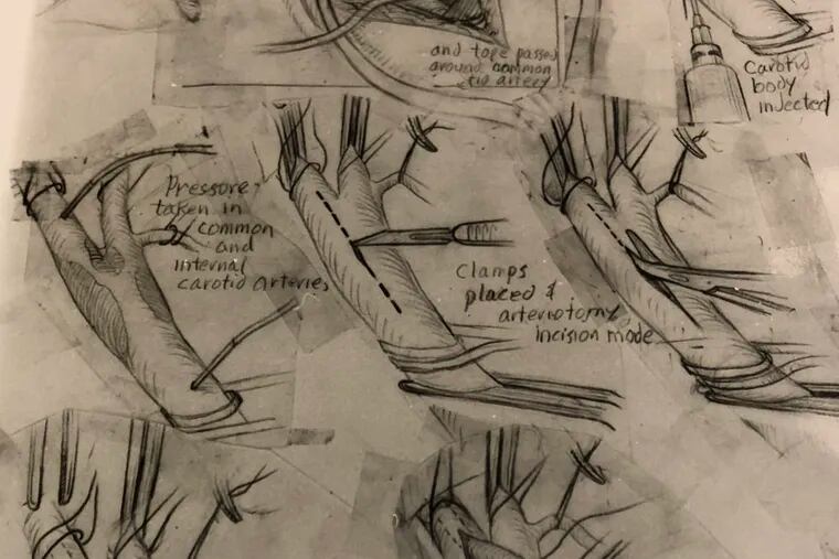 The earliest recorded descriptions of carotid endarterectomy, a procedure that reduces the risk of stroke, by surgeon Michael E. DeBakey, who first performed it in 1953. The authored reviewed this images as part of a U.S. National Library of Medicine fellowship.