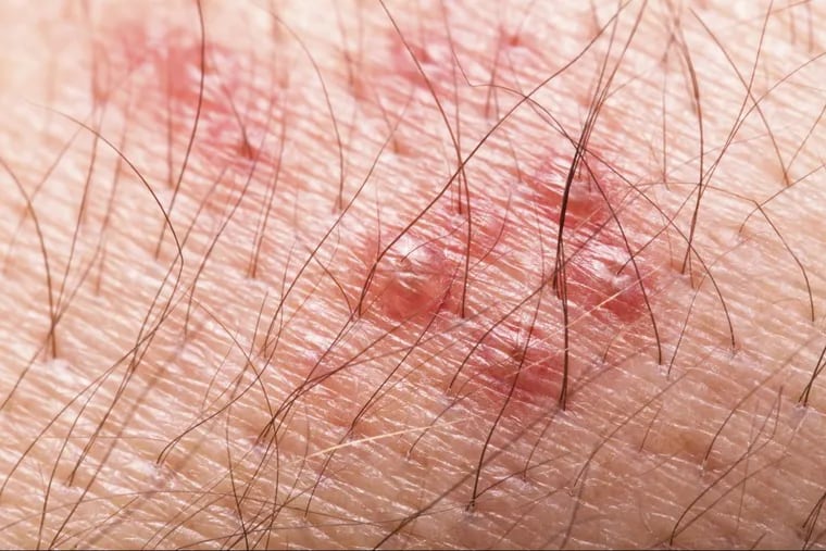 Herpes zoster (shingles) rash with blisters.