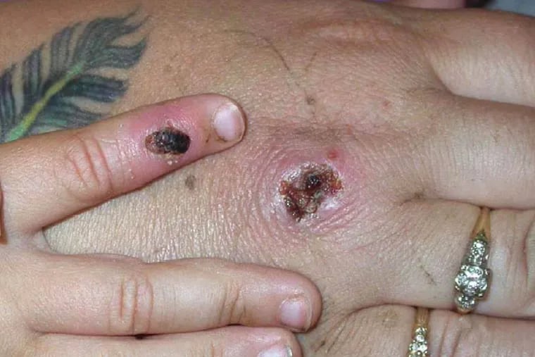 In this Centers for Disease Control and Prevention handout graphic, symptoms of one of the first known cases of the monkeypox virus are shown on a patient's hand on June 5, 2003. (CDC/Getty Images/TNS)