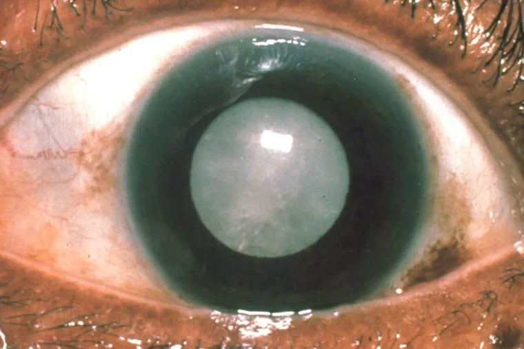 Cataract, Anterior Segment