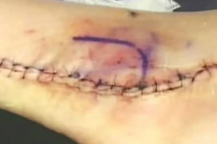 Curt Schilling shared with his followers the photo of his surgically repaired ankle.