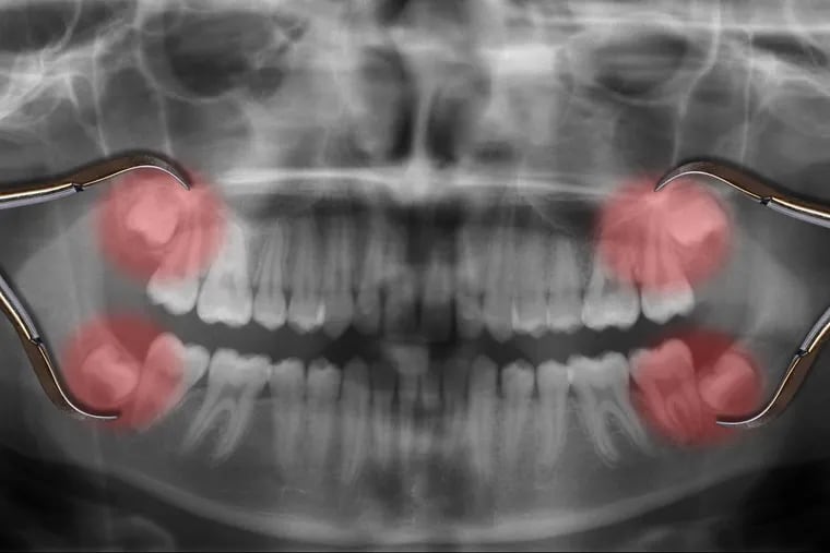 Taking opioids after having  wisdom teeth removed may set the patient up for more long-term drug use.