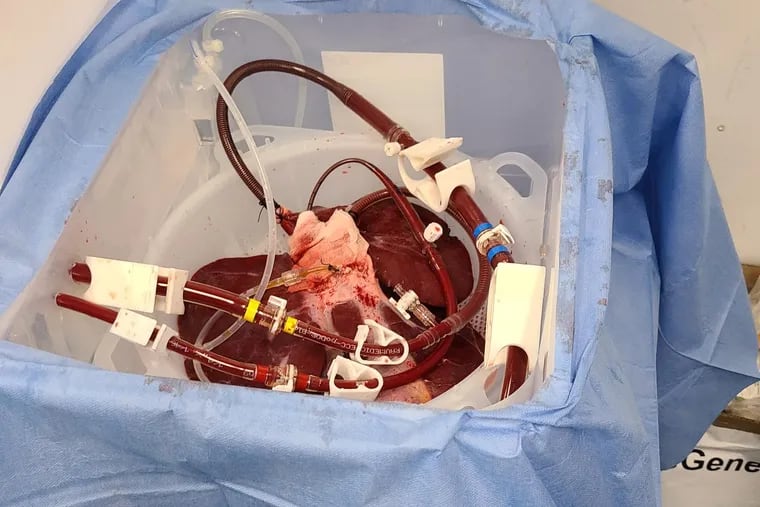 Penn Medicine’s Porcine Liver Test Case Shows Promising Results for Transplant Patients
