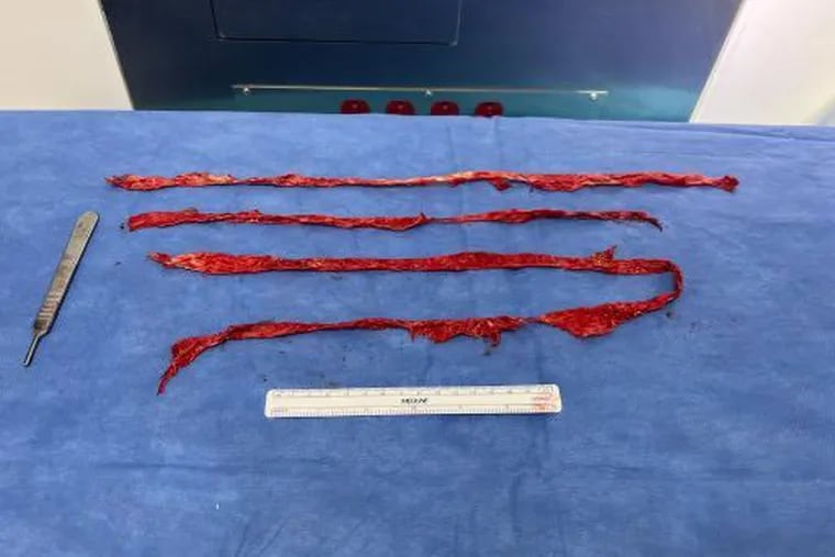 From 2017 to 2022, about 200 patients were treated in Philadelphia-area hospitals for objects that were left inside them during surgery, an Inquirer analysis found.