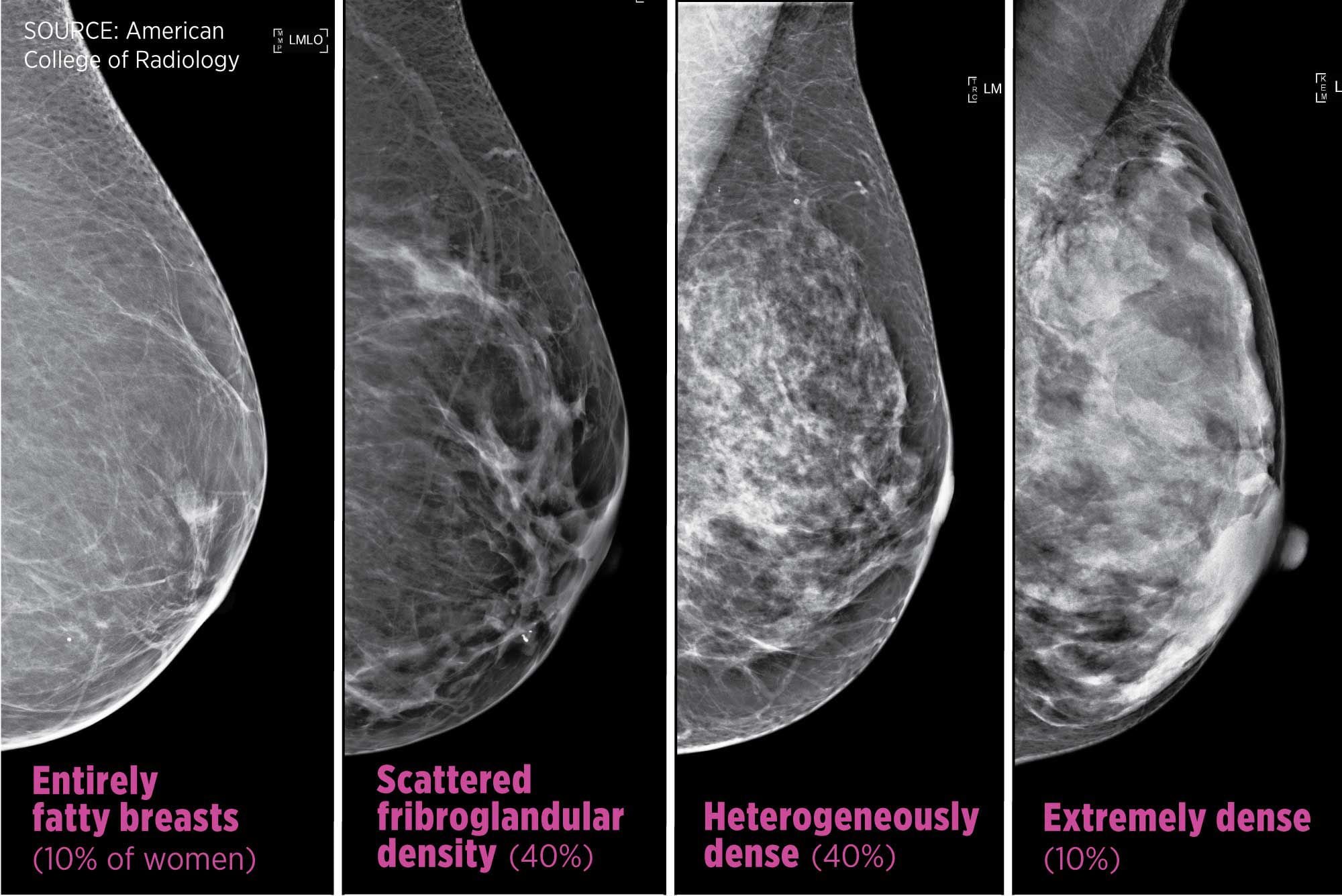 FDA has new mammogram guidelines for dense breast disclosure. What do the  rules mean for Pennsylvania residents?