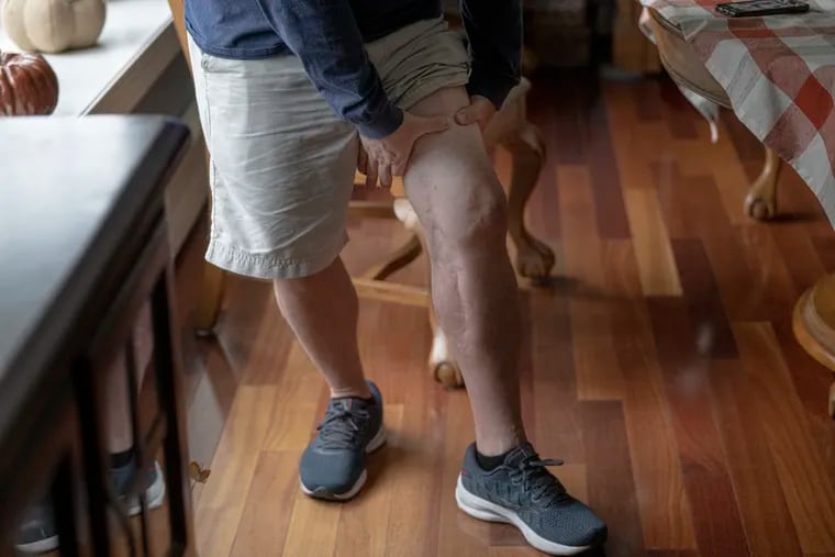 Philadelphia police lieutenant Robert Friel shows where a colleague placed a tourniquet on his left leg, allowing him to survive a bullet that shattered his thighbone and severed his femoral artery.