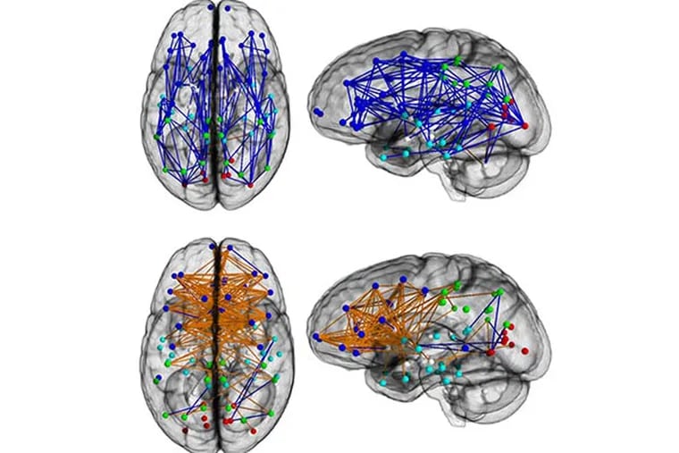 Brain networks show increased connectivity from front to back and within one hemisphere in males (upper) and left to right in females (lower). (Image courtesy Ragini Verma, PhD, Proceedings of National Academy of Sciences)