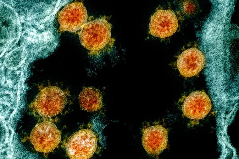 This electron microscope image shows coronavirus particles isolated from a patient. University of Hong Kong scientists said genetic tests have confirmed the first case of reinfection. A 33-year-old man who tested positive in March and four months later was infected by two different strains of the virus. (NIAID/National Institutes of Health via AP)
