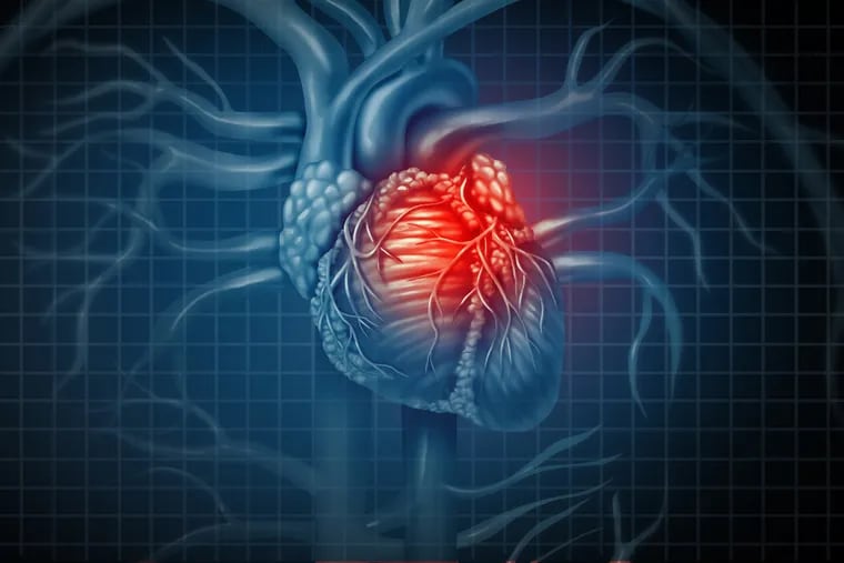 Some people don’t experience the classic symptoms of a heart attack, or don’t experience them as severely. This is known as an atypical presentation, or “silent” heart attack.