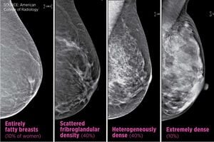 How often should you get a mammogram? It depends on whether you have dense  breast tissue, experts say - Los Angeles Times