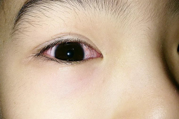 Close-up image of pink-eye, or conjunctivitis.