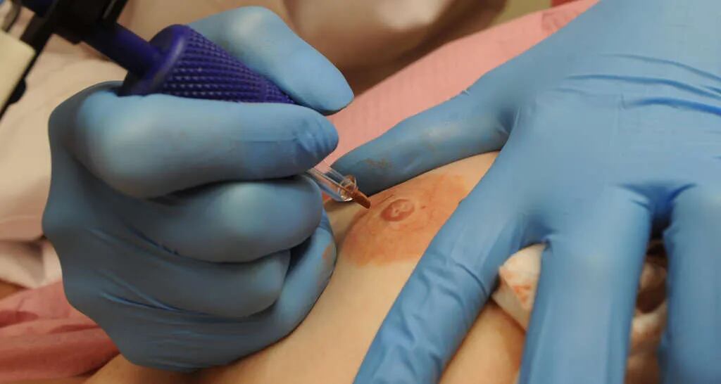Nipple tattoos, the finishing touch on breast reconstruction after cancer