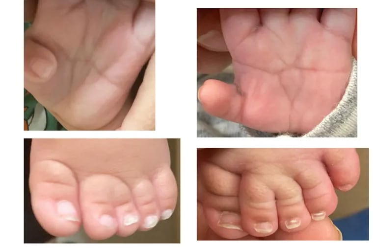 Babies whose parents used fentanyl during pregnancy can have birth defects such as smaller heads, underdeveloped jaws, and conjoined toes as shown at bottom, Nemours Children's Health physicians say. Some also have short, broad thumbs and a single horizontal crease on their palms (top), instead of the usual two creases.