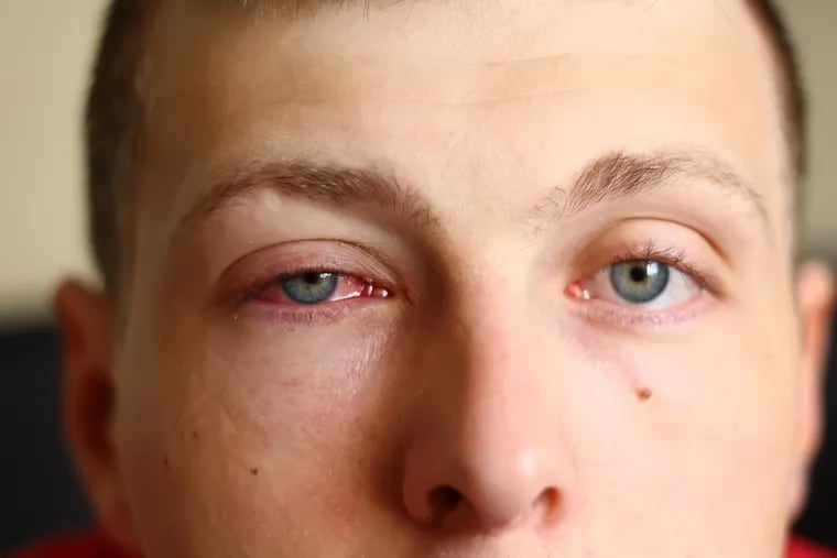 Eye doctors warn that conjunctivitis, a common condition, can be caused by coronavirus.