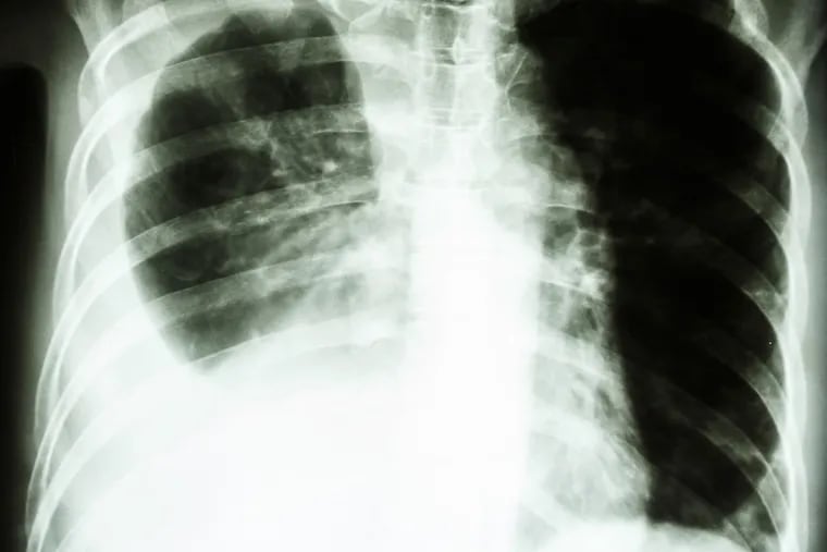 A view of a close up of a lung X-ray of a cigarette smoker.