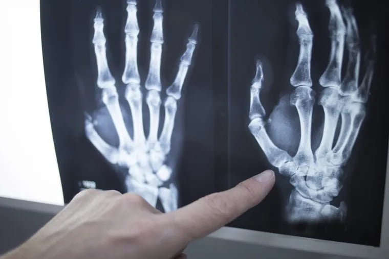 Arthritis pain at the base of her thumb led this patient to seek surgery.