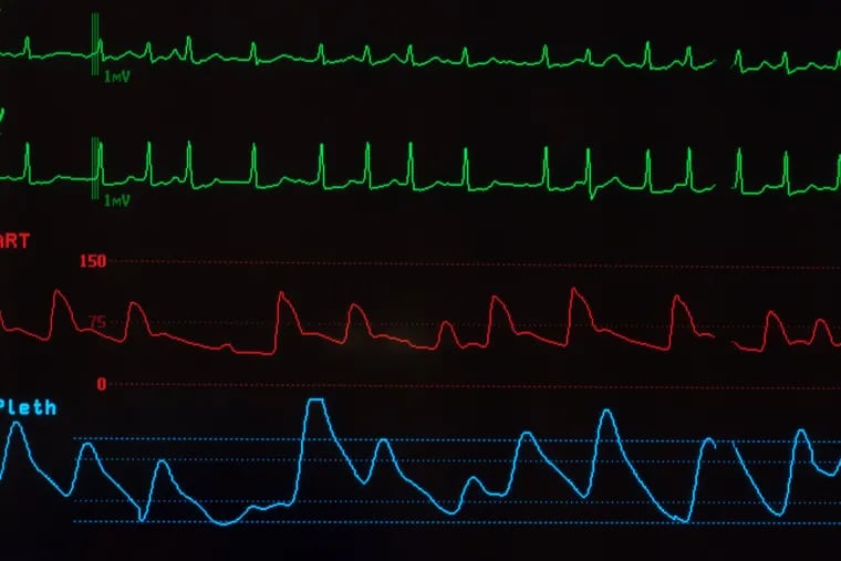 A monitor with a black screen showing atrial fibrillation on the green lines, arterial blood pressure on the red line and oxygen saturation on the blue line.